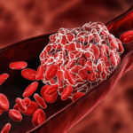 Embalmer alarmed by mysterious blood clots in vaccinated people | USNN World News Embalmer alarmed by mysterious blood clots in vaccinated people