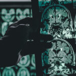 A Single Brain Scan to Diagnose Alzheimer’s Disease | USNN World News A Single Brain Scan to Diagnose Alzheimer’s Disease