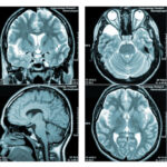 Brain Injuries After COVID Vaccination | USNN World News Brain Injuries After COVID Vaccination