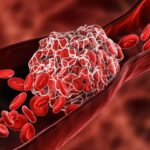 Blood Clotting May Be Causing Long COVID and Vaccine Injury: How to Get Better | USNN World News Blood Clotting May Be Causing Long COVID and Vaccine Injury: How to Get Better
