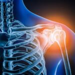 Frozen Shoulder: An Inflammatory Condition and 6 Top Exercises for Relief | USNN World News Frozen Shoulder: An Inflammatory Condition and 6 Top Exercises for Relief