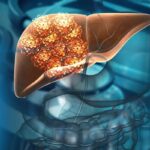 Liver Cancer: Diagnosis and Treatment for a 'Silent' Threat | USNN World News Liver Cancer Diagnosis and Treatment for a 'Silent' Threat