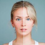 Rosacea: Symptoms, Causes, Treatments, and Natural Approaches | USNN World News Rosacea: Symptoms, Causes, Treatments, and Natural Approaches