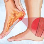 Plantar Fasciitis: Symptoms, Causes, Treatments, and Natural Approaches | USNN World News Plantar Fasciitis: Symptoms, Causes, Treatments, and Natural Approaches