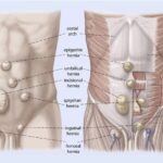 Hernia: Symptoms, Causes, Treatments, and Natural Approaches | USNN World News Hernia: Symptoms, Causes, Treatments, and Natural Approaches