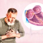 Atrial Fibrillation: Symptoms, Causes, Treatments, and Natural Approaches | USNN World News Atrial Fibrillation: Symptoms, Causes, Treatments, and Natural Approaches