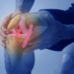 Common Knee Surgery Linked to Arthritis: Study | USNN World News Common Knee Surgery Linked to Arthritis: Study