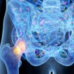 An Overlooked Driver of Osteoporosis | USNN World News An Overlooked Driver of Osteoporosis